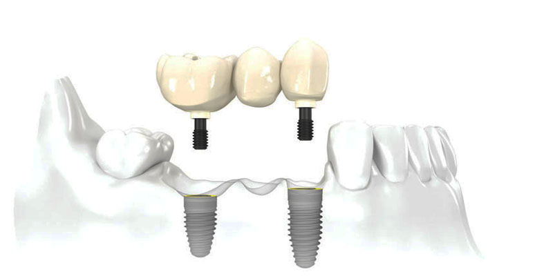 Implant Bridge at PERFECT SMILE